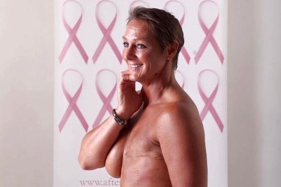 Baring all after breast cancer