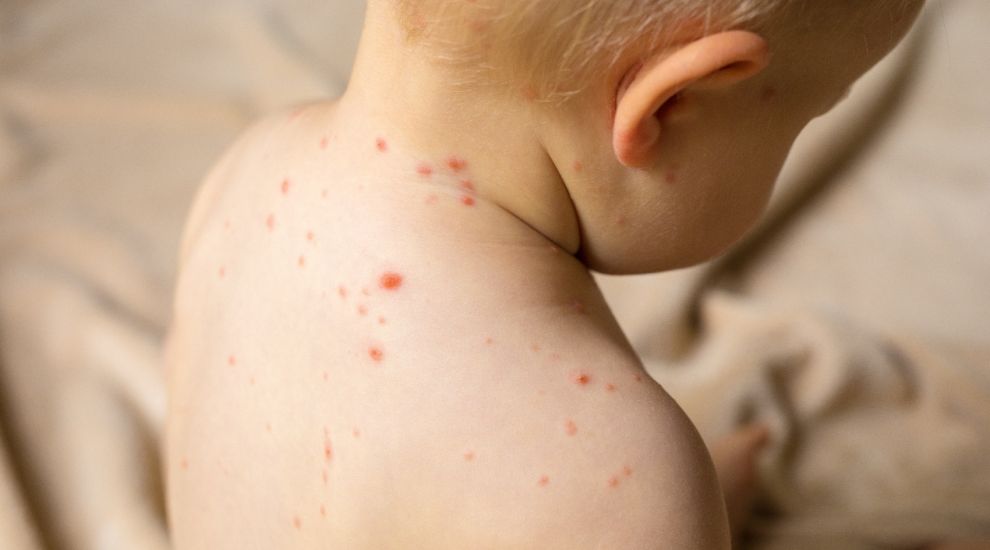 Jersey to follow UK recommendation on chickenpox vaccine for children