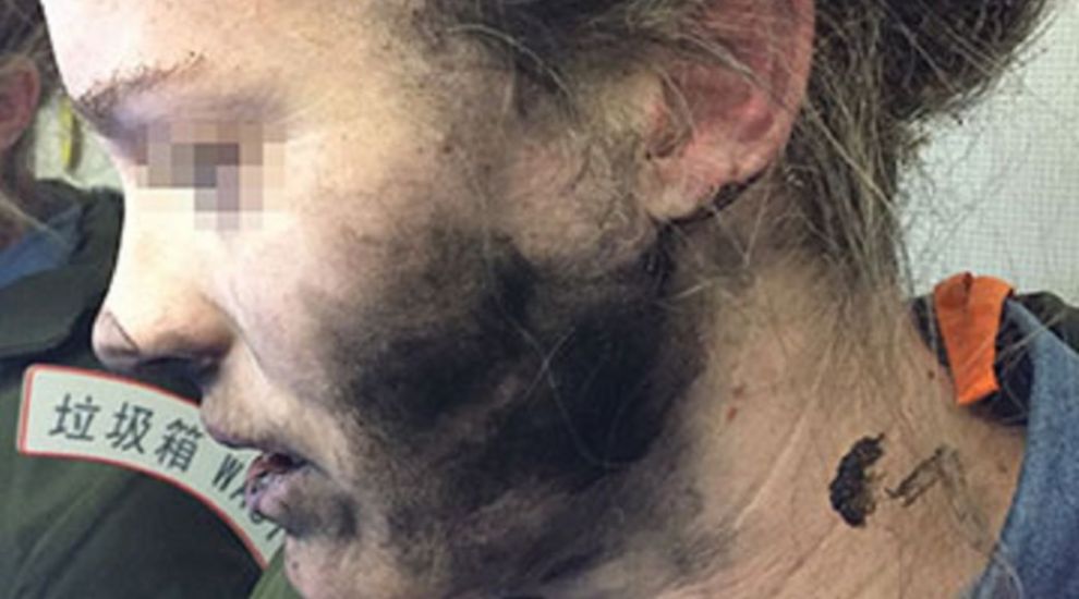 This airline passenger was left with burns after her headphones exploded