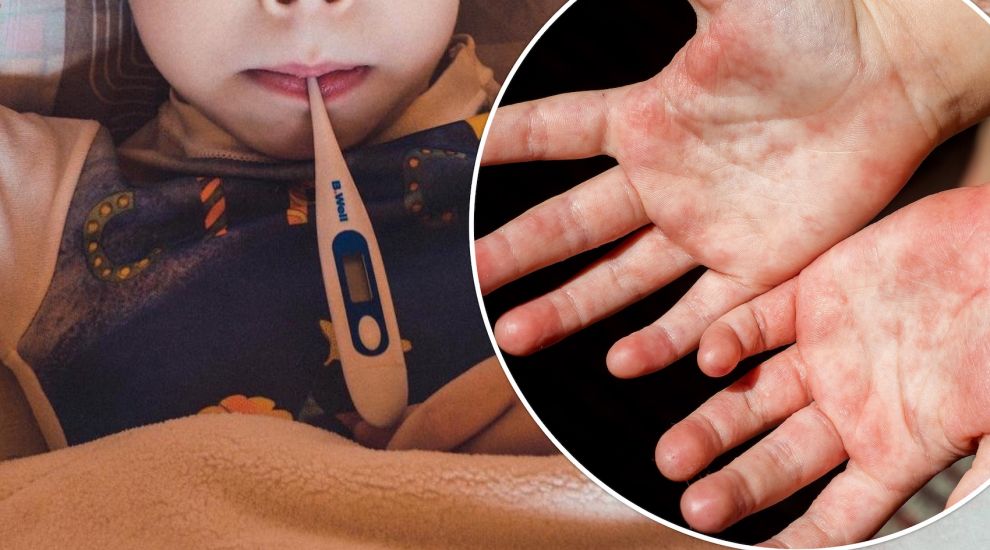 Scarlet Fever cases rise among Jersey nursery children