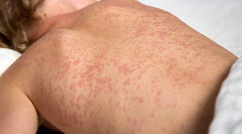 Jersey measles alert: Second confirmed case in less than a month